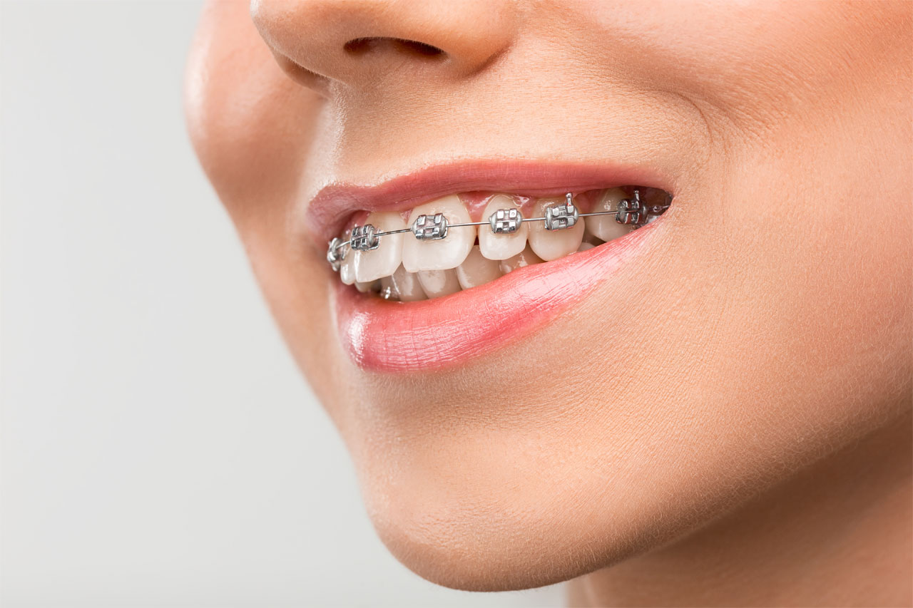 woman puts metal braces on her teeth